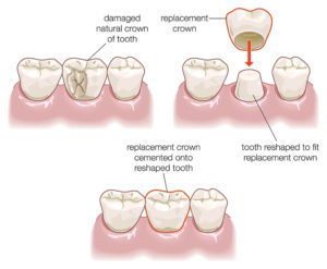 Dental-crown